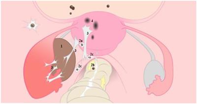 Diet associations in endometriosis: a critical narrative assessment with special reference to gluten